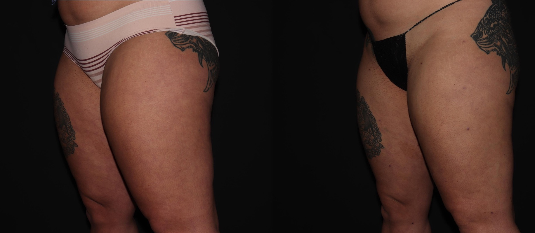 Before and After Image: Liposuction – Thighs - left-front-oblique